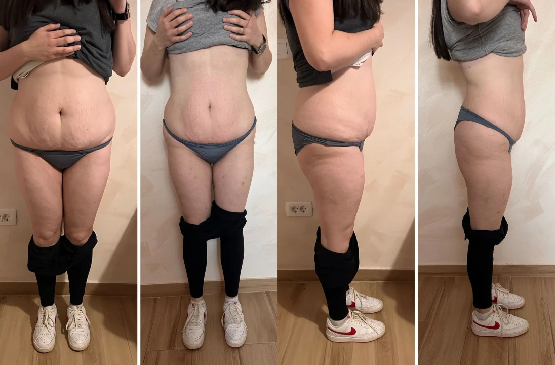 FOTO Beauty Clinic by Tamara: Smanjite celulit i ovo ljeto prošetajte plažom samouvjereno!