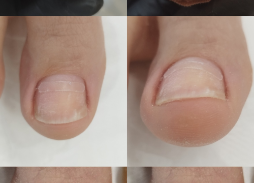 Fotografija 7 - Riješite se uraslih noktiju uz medicinsku pedikuru!