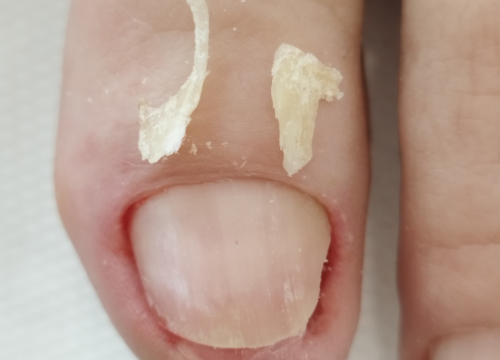 Fotografija 9 - Riješite se uraslih noktiju uz medicinsku pedikuru!