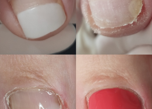 Fotografija 13 - Riješite se uraslih noktiju uz medicinsku pedikuru!