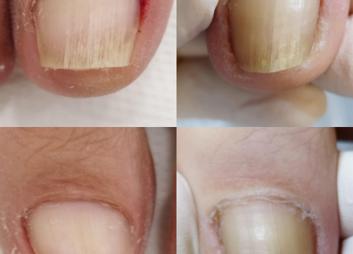 Fotografija 5 - Pružite svojim stopalima maksimalnu njegu i riješite tegobe uz medicinsku pedikuru!