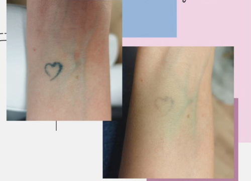 Fotografija 7 - Uz Glam by Ana uklonite trajnu šminku i tetovaže bez boli!