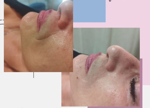 Fotografija 8 - Uz Glam by Ana uklonite trajnu šminku i tetovaže bez boli!