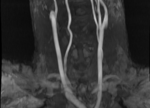 Fotografija 4 - Svjetski dan zdravlja: Ateroskleroza svjetski ubojica broj jedan