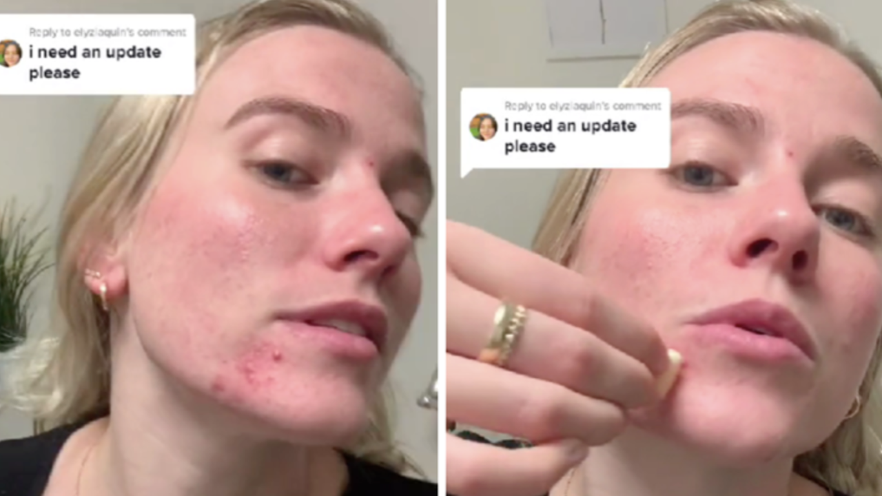 Novi TikTok trend: Beauty influenceri mažu lice s češnjakom