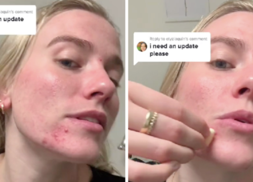 Novi TikTok trend: Beauty influenceri mažu lice s češnjakom