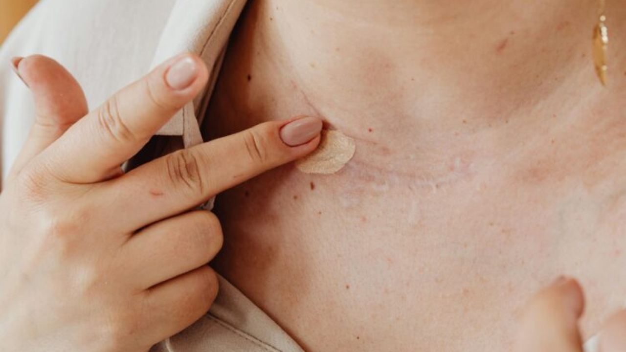 Uklonite ožiljke uz ove prirodne sastojke