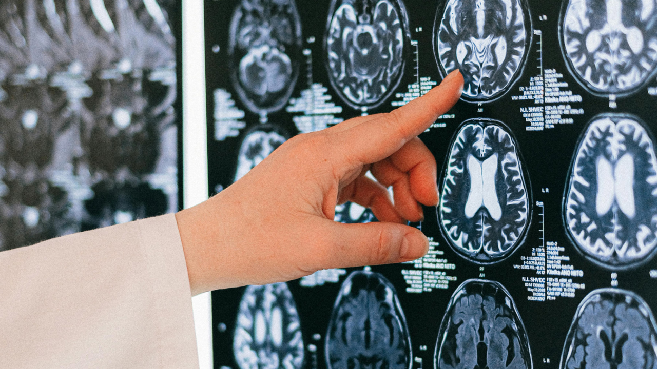 Porast oboljelih: Evo kako prepoznati multiplu sklerozu i tko je ugroženiji