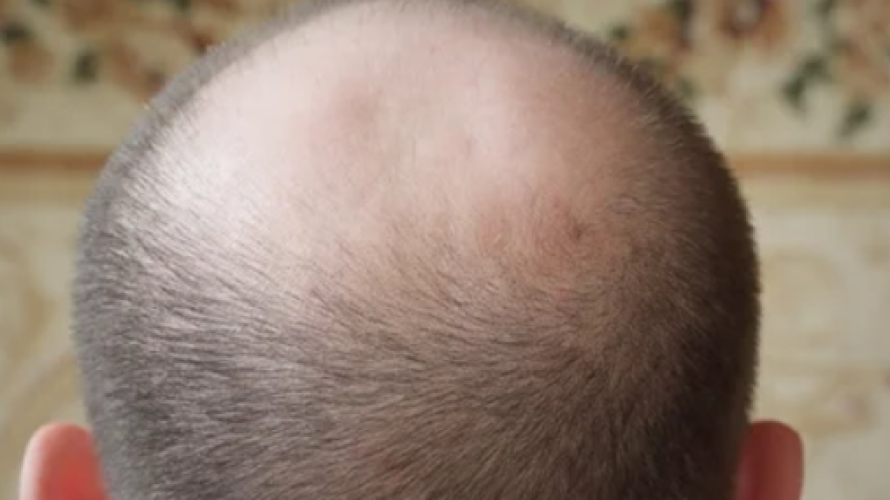 Hrvatska je među državama s najviše ćelavih muškaraca