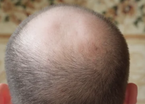 Hrvatska je među državama s najviše ćelavih muškaraca