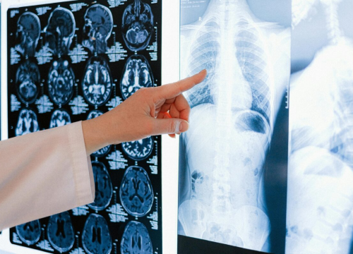 Ovo su najčešći simptomi raka pluća