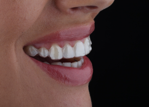 Fotografija 3 - FOTO Saznajte sve o prozirnim aparatićima na Danima otvorenih vrata Dental centra Dubravica!