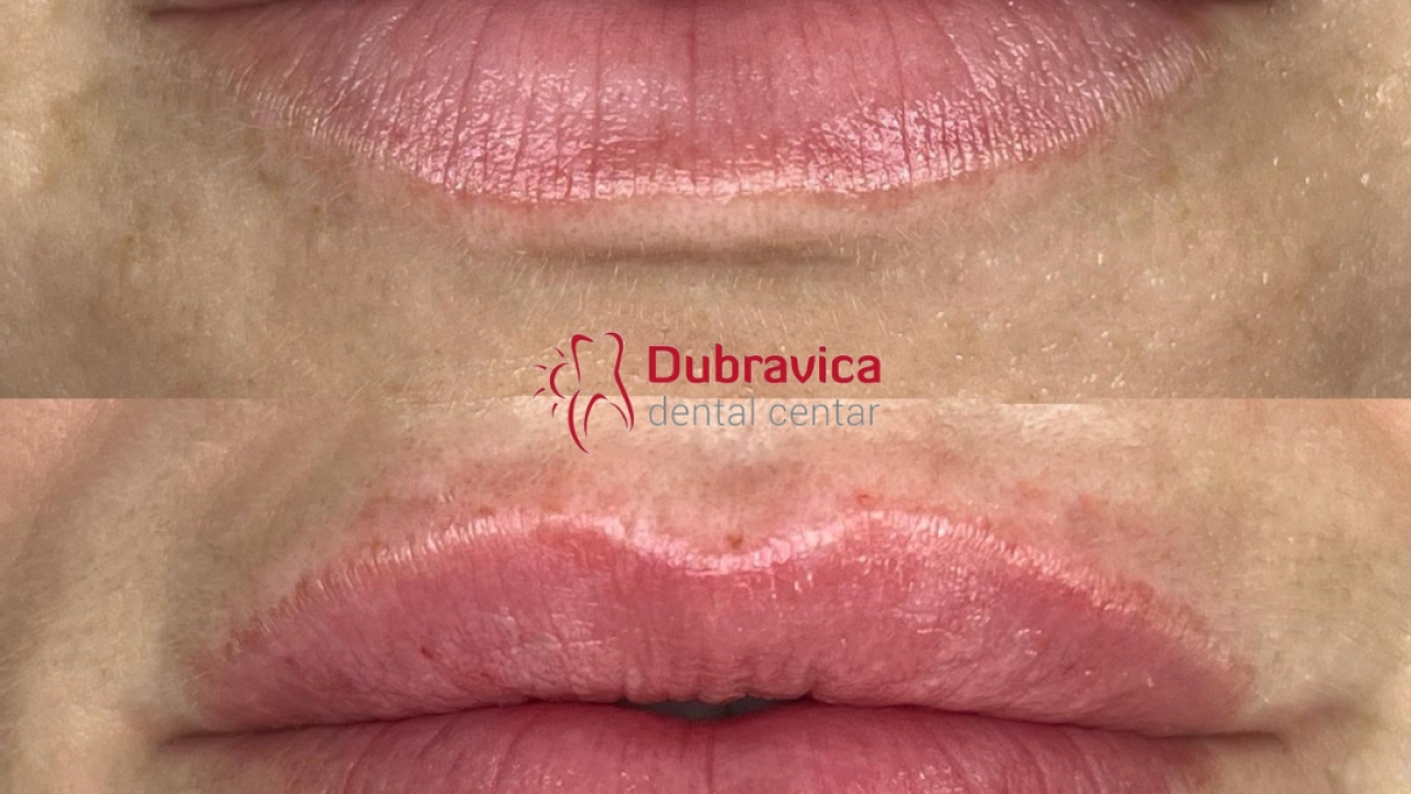 Dan žena u Dubravici: Iskoristite popust na najnovije trendove u estetskoj medicini