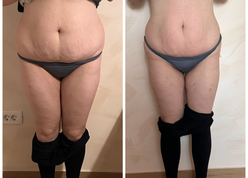 Fotografija 5 - FOTO Beauty Clinic by Tamara: Smanjite celulit i ovo ljeto prošetajte plažom samouvjereno!