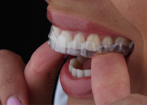 Fotografija 3 - FOTO Transformirajte osmijeh prozirnim alignerima u Dental centru Dubravica!