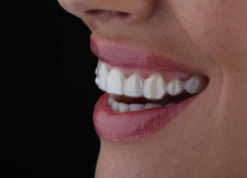 Fotografija 5 - FOTO Transformirajte osmijeh prozirnim alignerima u Dental centru Dubravica!